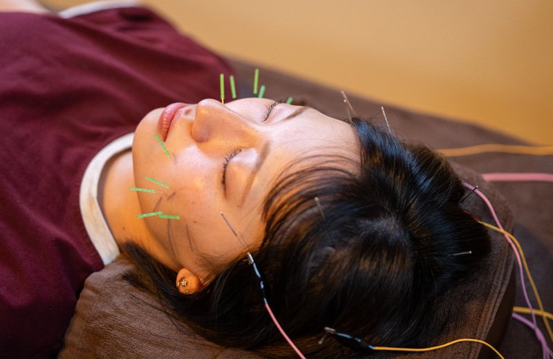 リフトアップ美容鍼　通常コース