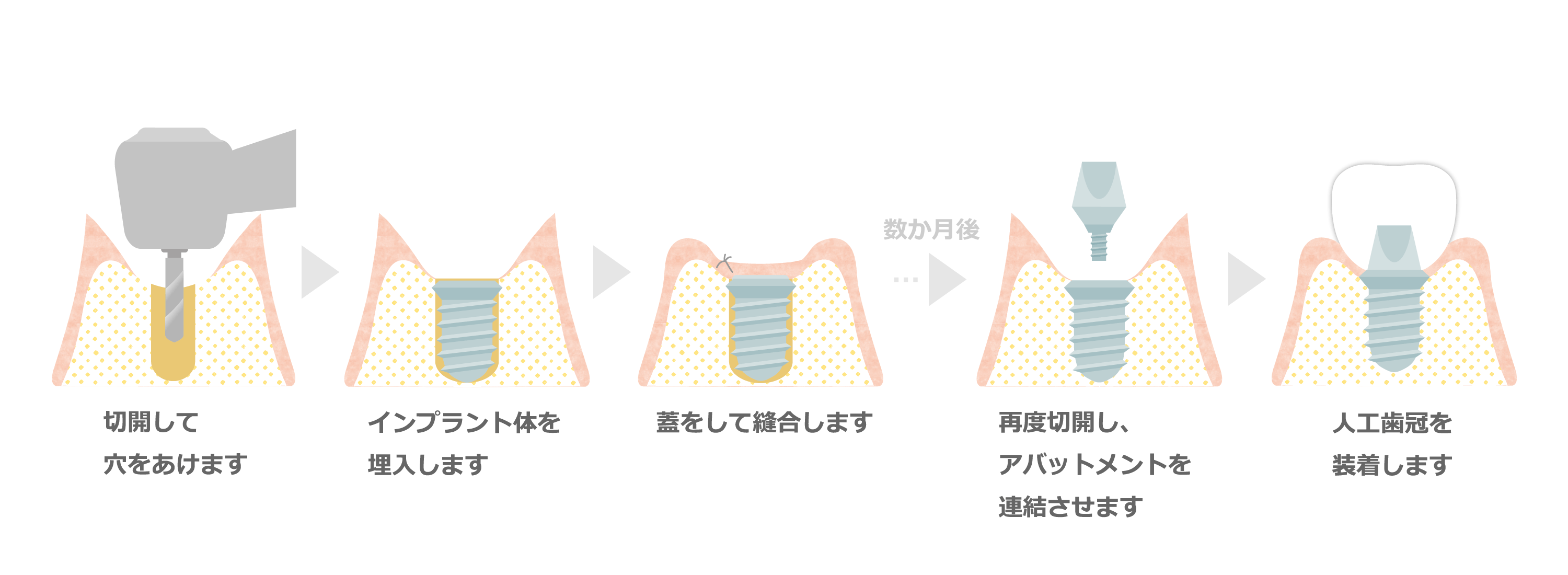 福島市でインプラント治療をお探しなら赤塚歯科クリニックへ